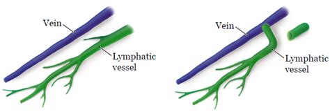 Q&A: Lymphaticovenous Bypass to Treat Lymphedema After 